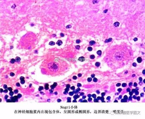 mallory小体是什么意思