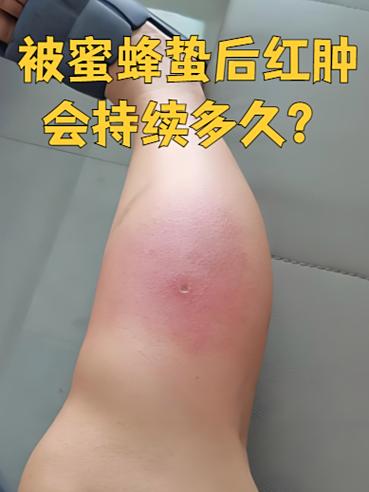 被大黄蜂咬一口怎么办